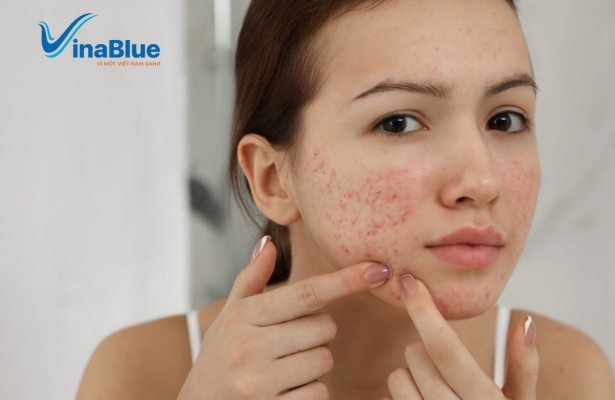 Nổi mụn bất thường là dấu hiệu sớm cho thấy gan đang bị quá tải