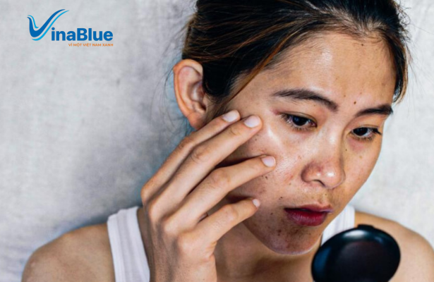 Da nhiễm chì là kết quả do tiếp xúc với môi trường lâu ngày cùng chu trình chăm sóc da không phù hợp