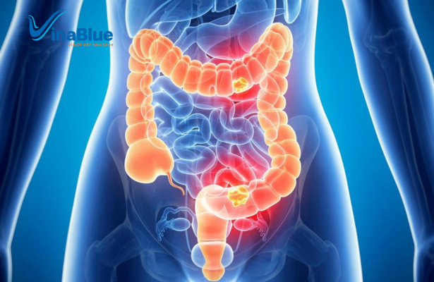 Đại tràng không được thải độc định kỳ dễ gây tình trạng suy giảm chức năng và gây rối loạn tiêu hoá kéo dài