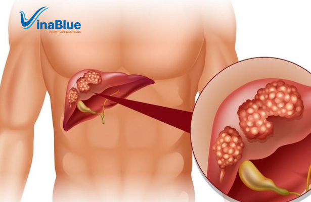 Thải độc gan là quá trình cơ thể loại bỏ độc tố từ bên trong